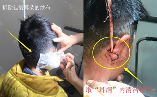 幼童小耳畸形矫正术后恢复，规避发炎感染需要这样做！