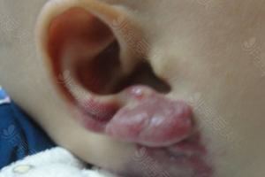 耳部血管瘤照片
