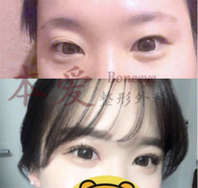 韩国本爱整形眼部修复手术案例展示