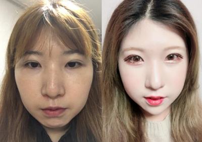 韩国本爱整形医院面部综合整形手术前后对比照片