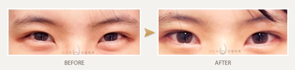 韩国DNA双眼皮修复对比