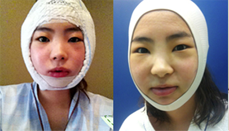 韩国梦想整形外科轮廓手术副作用？