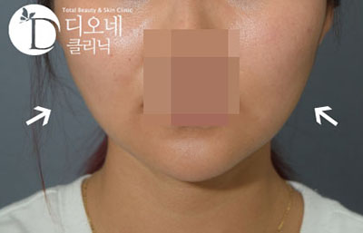 韩国注射瘦脸针瘦脸效果图
