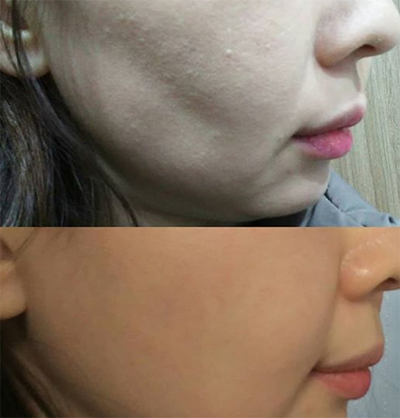 韩国NVU整形外科面部脂肪移植案例