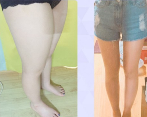 韩国维摩整形医院吸脂瘦大腿前后对比图