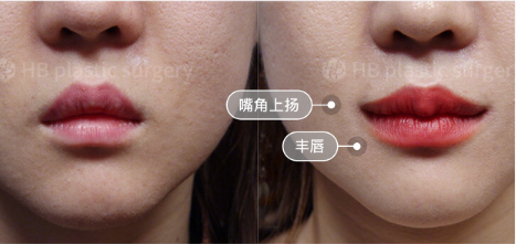 韩国HB整形外科唇部整形手术案例