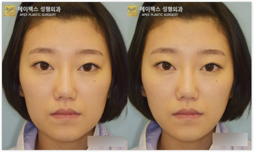 韩国瘦脸针瘦咬肌案例