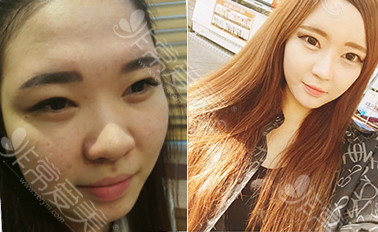韩国apex面部脂肪移植案例对比