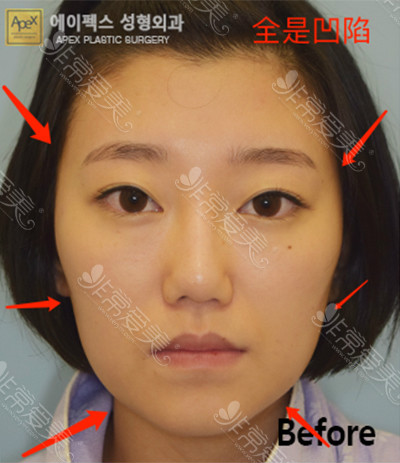 韩国面部脂肪移植案例对比
