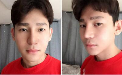 韩国GNG整形医院男士鼻修复术后一个月对比