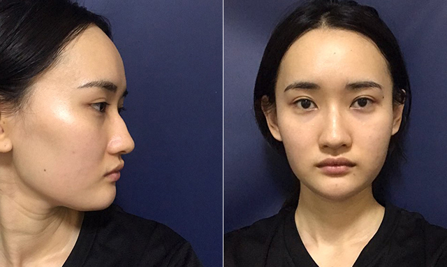 2019年韩国鼻整形模版告诉你，韩式翘鼻适合什么脸型！
