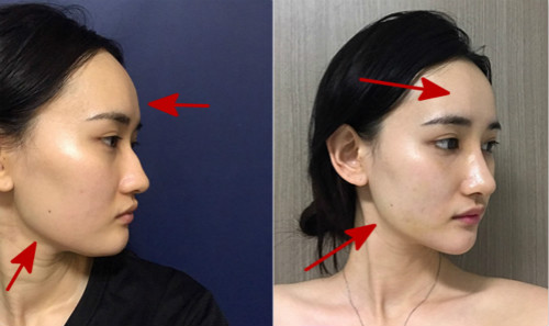 2019年韩国鼻整形模版告诉你，韩式翘鼻适合什么脸型！