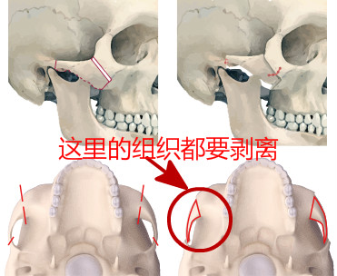 韩国3D颧骨手术示意图
