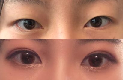 韩国DI整形外科双眼皮