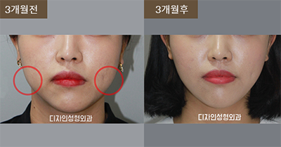 韩国釜山design整形医院面部吸脂手术对比案例