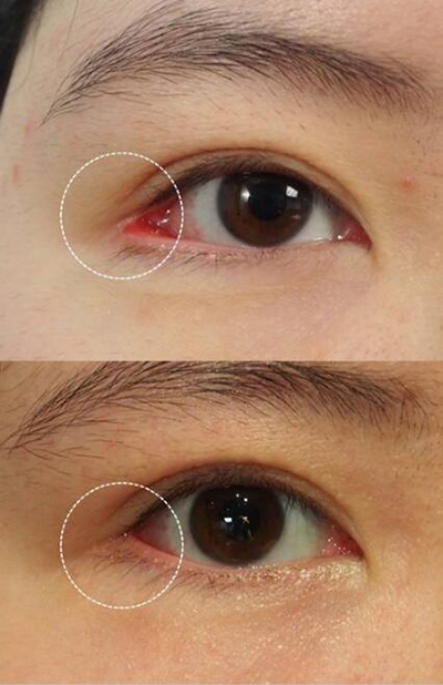 韩国天鹅（swan）整形外科外眼角修复照片