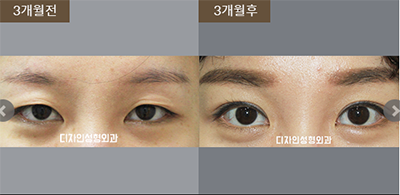 韩国釜山design整形医院眼部手术对比案例