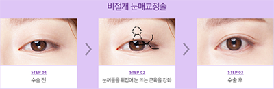 釜山design整形眼部手术特点