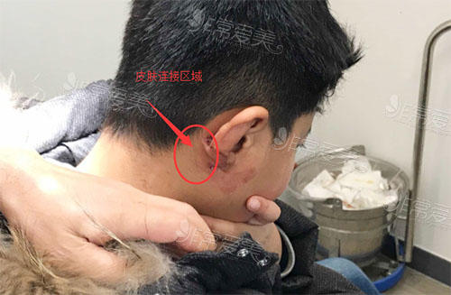 韩国普罗菲耳医院耳畸形矫正图