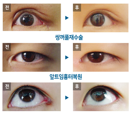 韩国swan眼部修复对比