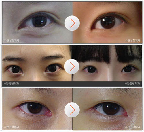 韩国swan眼部修复整形