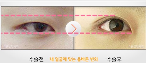 韩国天鹅swan整形医院黄成浩做双眼皮手术