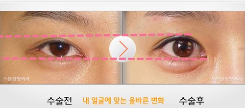 韩国天鹅swan整形医院黄成浩做双眼皮真人对比