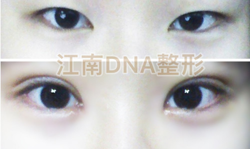 韩国江南DNA整形医院院长金沅硕（金沅奭）做无粘合开后眼角真人对比