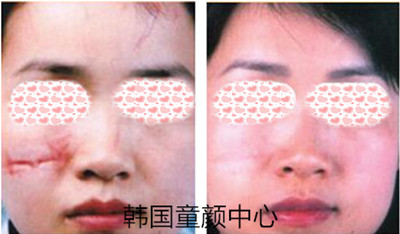 韩国童颜中心皮肤管理真人对比