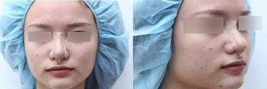 韩国inno整形外科玻尿酸填充鼻子对比