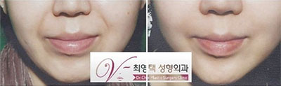 韩国dr.choi注射瘦脸针祛法令纹案例对比
