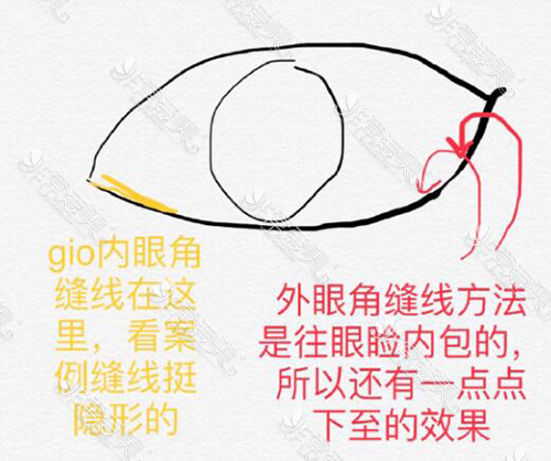韩国GIO眼部缝合方法照片