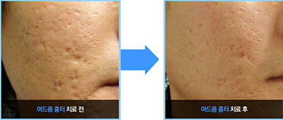 韩国DK整形外科皮肤疤痕痘印治疗照片