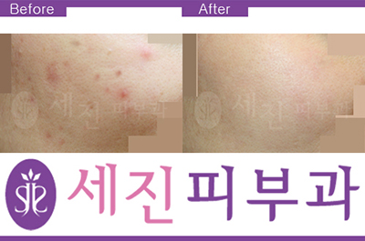 韩国世珍皮肤治疗照片