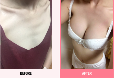 韩国玛博尔整形外科假体隆胸图
