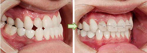 双鄂手术牙齿对比照片