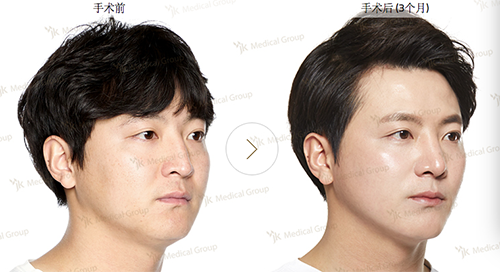 韩国JK整形外科鼻部矫正手术