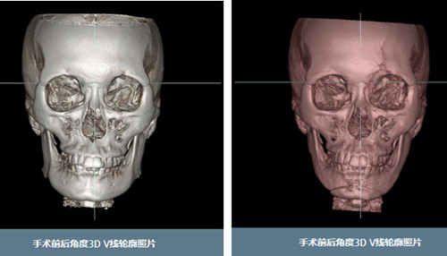 英格金明镇轮廓术后3D-CT对比图片
