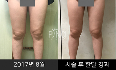 韩国PING医院大腿吸脂照片