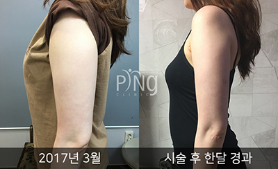 韩国PING整形外科皮肤科手臂吸脂照片