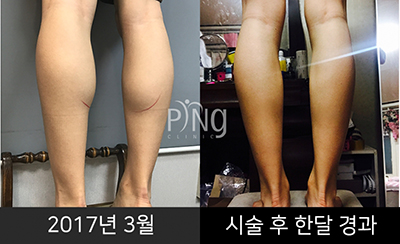 韩国PING整形外科皮肤科小腿消退整形照片