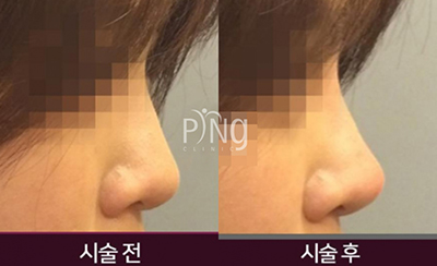 韩国PING整形外科皮肤科隆鼻照片