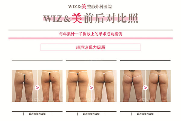 韩国wiz美吸脂案例对比