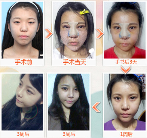 韩国乐得整形外科隆鼻案例恢复图