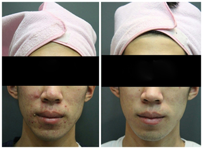 韩国童颜中心面部痤疮治疗前后照片