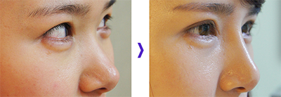 韩国jstar整形外科隆鼻手术对比案例
