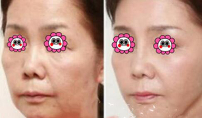 韩美人皮肤科医院超声提升美肤对比照片
