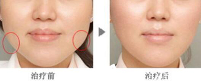 韩美人皮肤科医院瘦脸针瘦脸对比照片