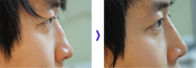 鼻部整形手术对比案例