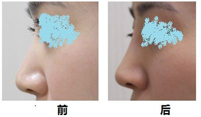 韩国允（雅秘珠）整形外科玻尿酸隆鼻前后对比照片